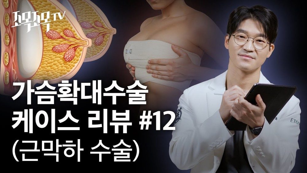 가슴확대수술 케이스 리뷰 #12 - 근막하