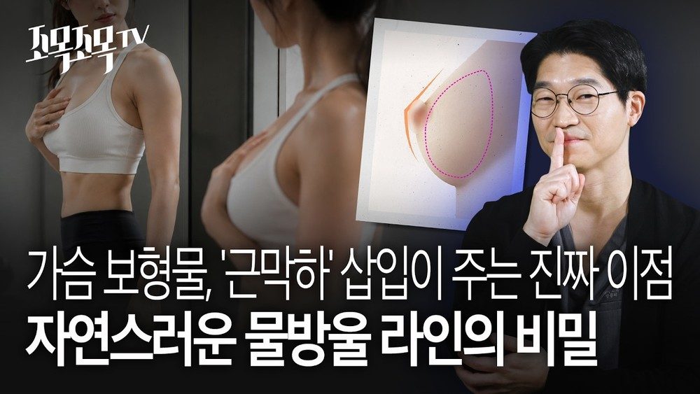 가슴 보형물, '근막하(Subfascial)' 삽입이 주는 진짜 이점: 자연스러운 물방울 라인의 비밀