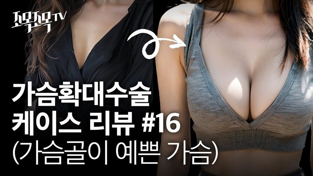 가슴확대수술 케이스 #16 - 가슴골이 예쁜 가슴