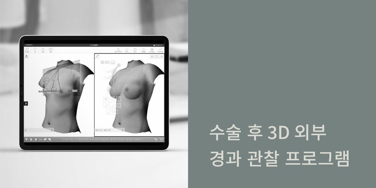 애프터케어 장면 1: 수술 후 3D 외부 경과 관찰 프로그램