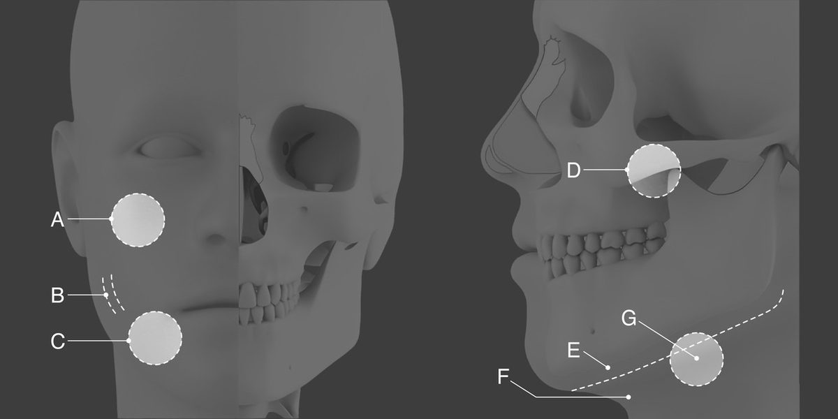 얼굴·두개골 3D 모델 정면·측면. 정면에 볼 지방(A)·리프팅 라인(B)·턱 지방(C), 측면에 광대(D)·턱선(E,F)·지방 부위(G) 위치 표시
