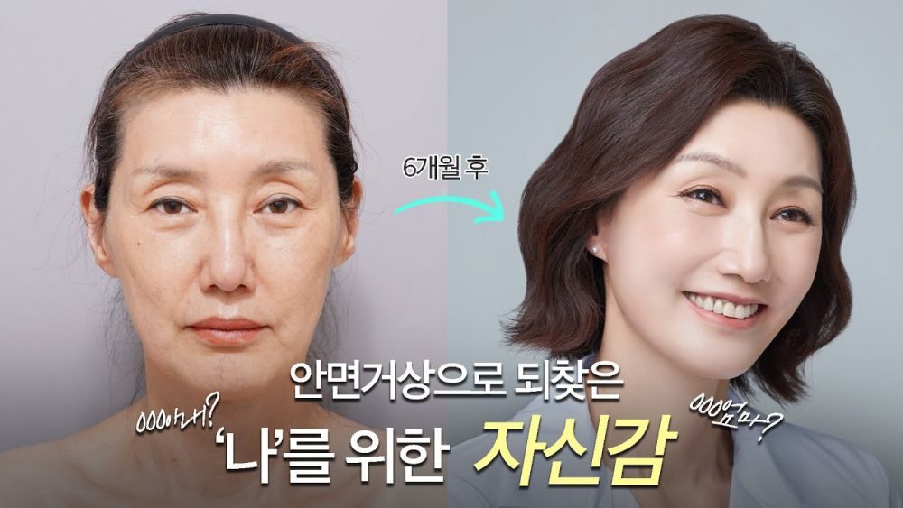 안면거상으로 되찾은 엄마의 자신감, 리얼 수술 후기