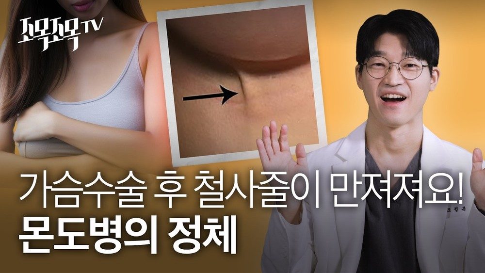 가슴 수술 후 배나 팔에 '철사줄'이 만져져요! : 몬도 병(Mondor's Disease)의 정체