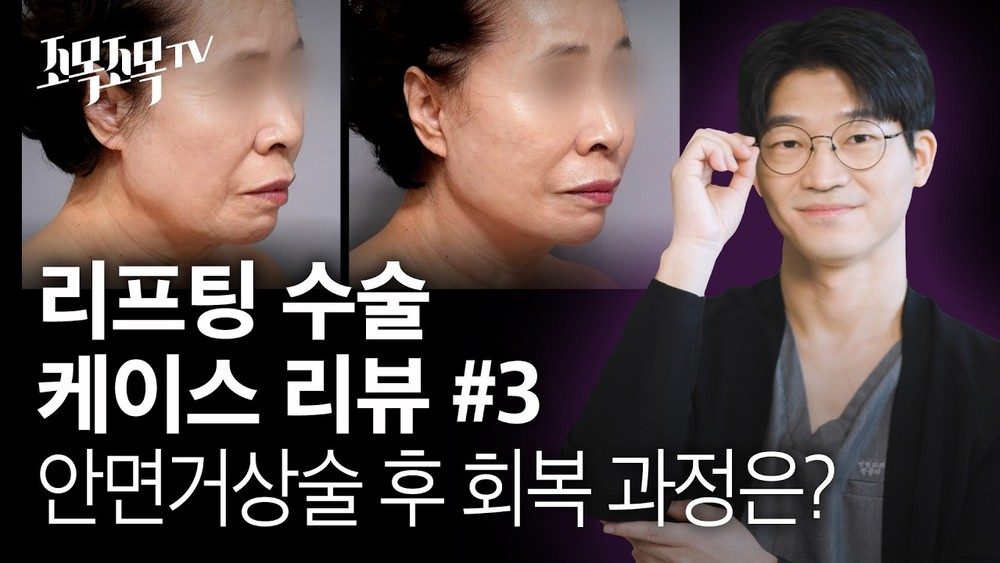 안면거상 수술 후 회복 과정은? [리프팅 수술 케이스 리뷰 3]