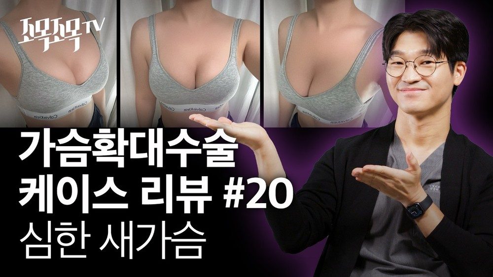가슴 확대 수술 케이스 #20 - 심한 새가슴