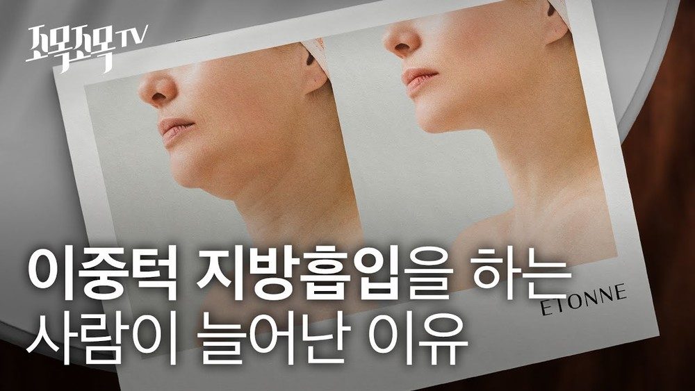 이중턱 지방흡입을 하는 사람이 늘어난 이유?