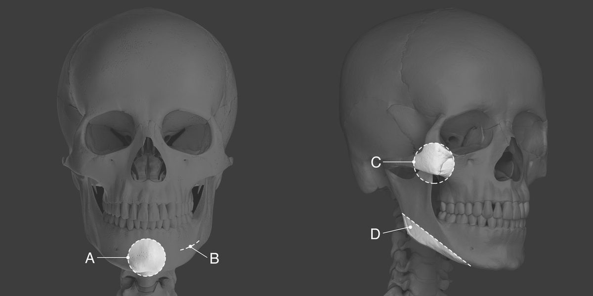 두개골 3D 모델 정면·측면. 정면에 턱끝(A)과 절골 라인(B), 측면에 광대(C)와 턱밑 각(D) 위치 표시