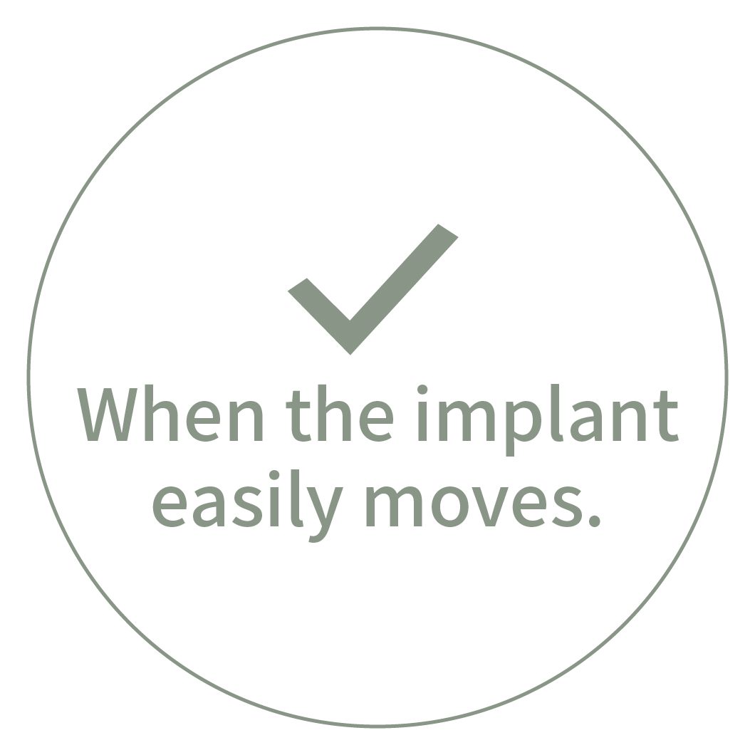 When the implant easily moves.