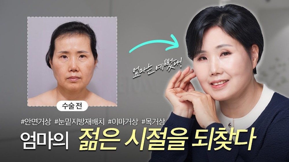 10년 젊어지는 안티에이징 수술 리얼 후기