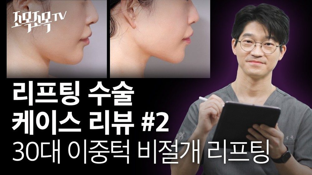 리프팅 수술 케이스 리뷰 #2 - 이중턱 비절개 리프팅