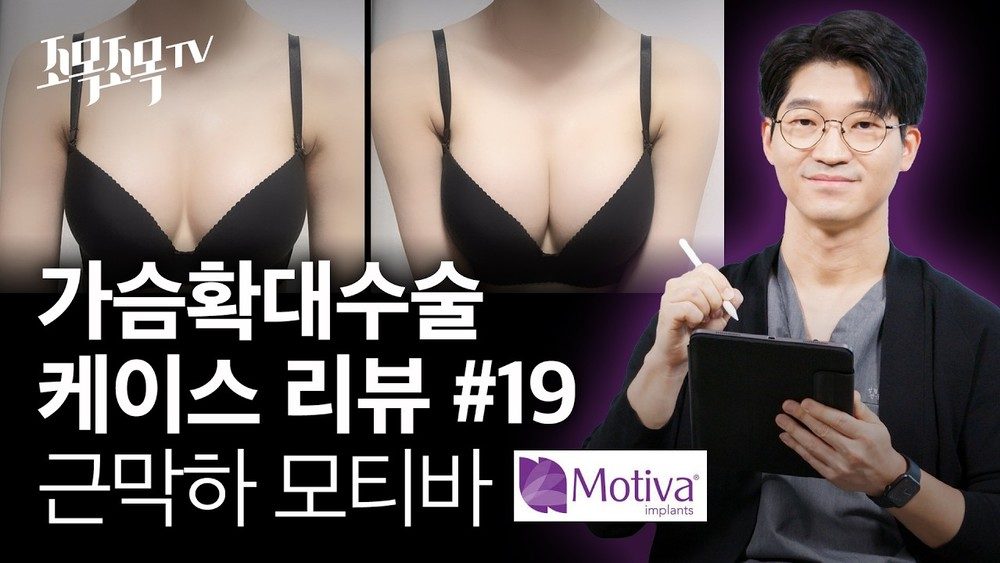 가슴 확대 수술 케이스 #19 - 근막하 모티바