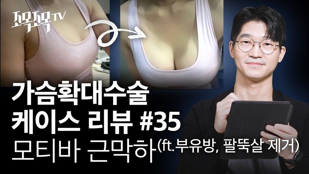 모티바 근막하 가슴확대수술 자연스러운 I골 만들기 (겨드랑이 절개) - 가슴확대수술 케이스 35