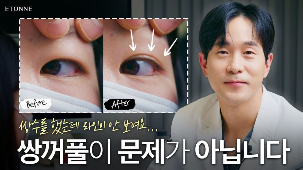 눈재수술 상담 갔는데 의사가 이마거상을 추천하는 이유