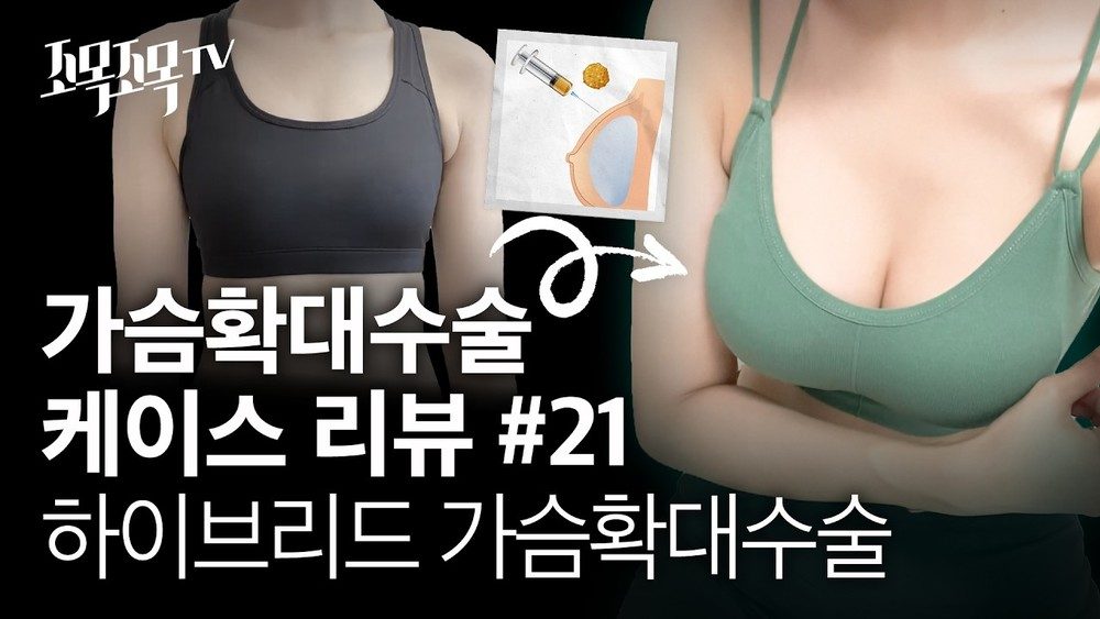 가슴확대 수술 케이스 #21 - 하이브리드 가슴성형술