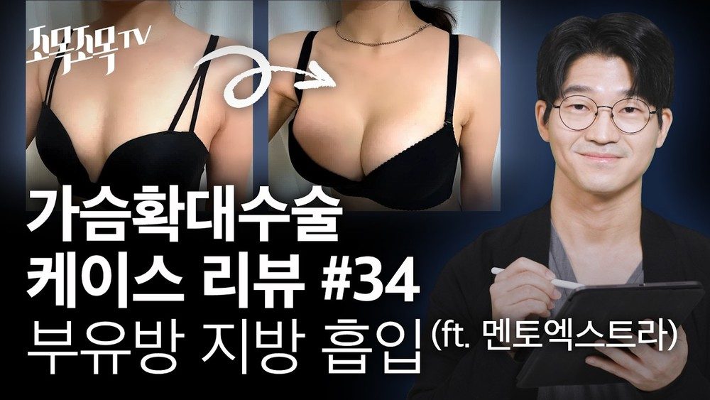 가슴확대수술 케이스34 - 근막하 + 부유방 지방흡입 (멘토 엑스트라)