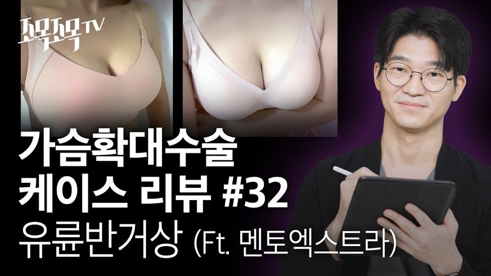 가슴확대수술 케이스32 - 멘토엑스트라, 유륜반거상