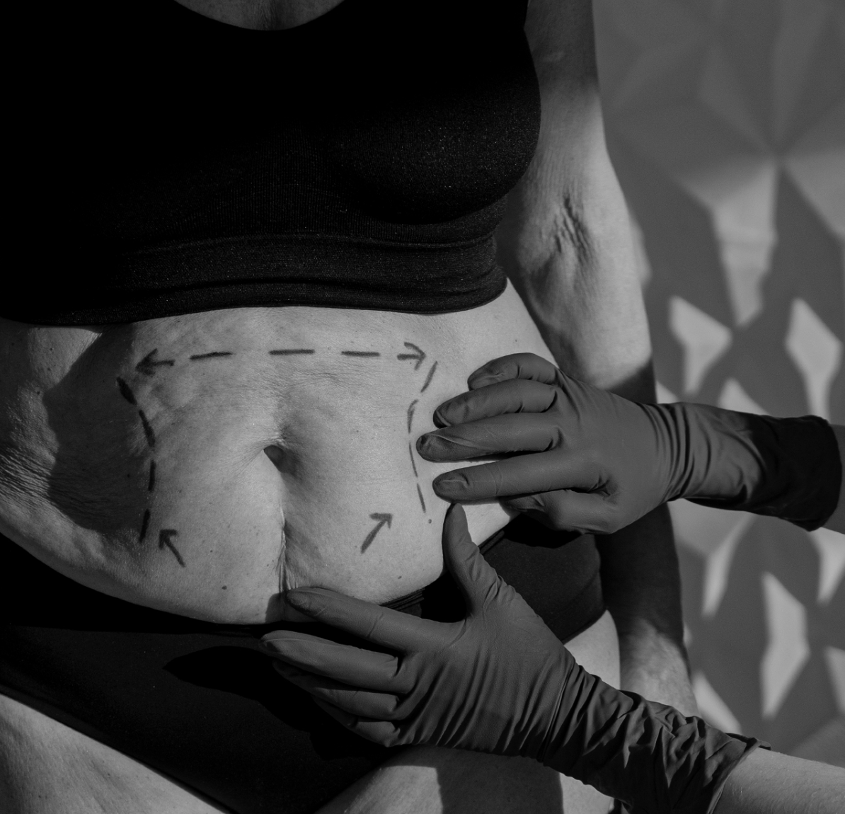 Black-and-white photo of gloved hands pointing to marking lines drawn on the surgical site
