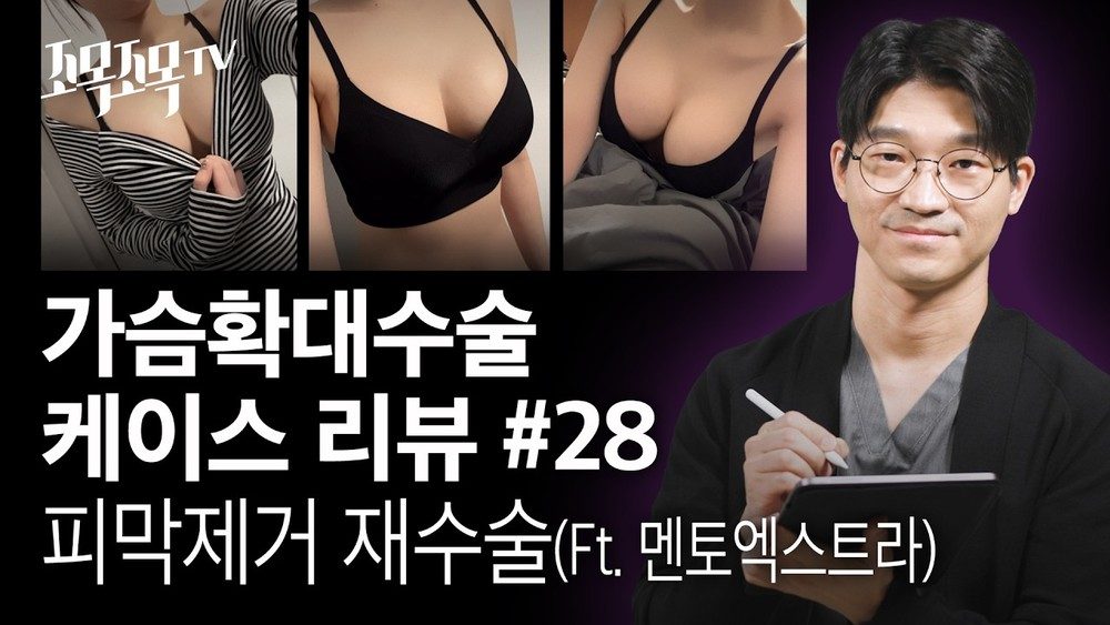 가슴확대수술 케이스리뷰 28 - 피막제거 재수술 멘토엑스트라