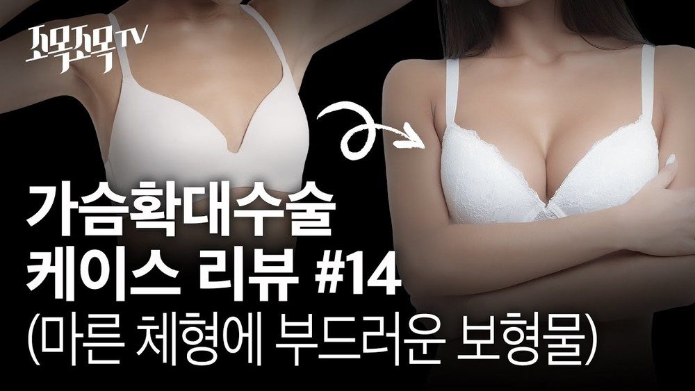 가슴확대수술 케이스 #14 - 마른 체형에 부드러운 보형물
