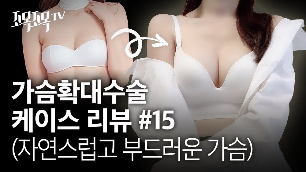 가슴 확대 수술 케이스 #15 - 자연스럽고 부드러운 가슴