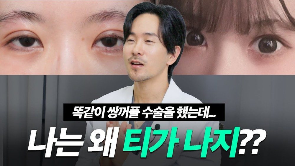 성형한 티가 안나면서 눈이 예뻐지는 방법