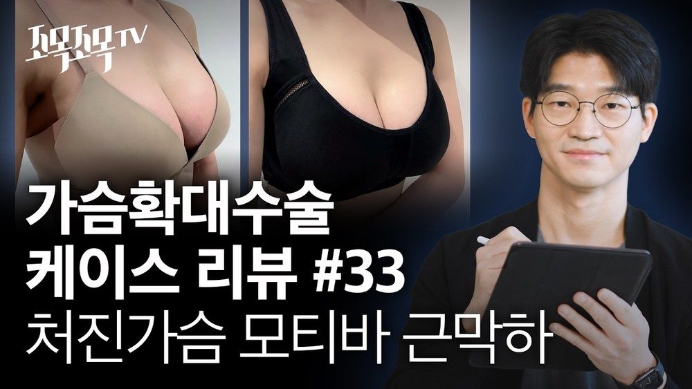 가슴확대수술 케이스33 - 처진가슴 모티바 근막하